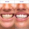 Hismile Teeth Whitening Duo