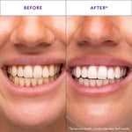 Hismile Teeth Whitening Duo