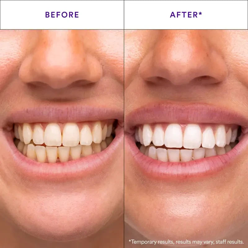 Hismile Teeth Whitening Duo